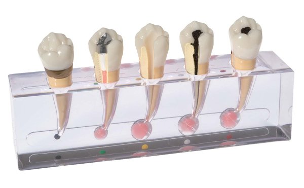 Endodontiemodell „Granulom“ P23-END.2